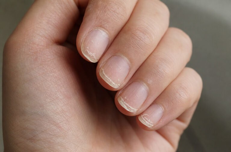 Close-up of a hand showing dry, peeling brittle fingernail tips